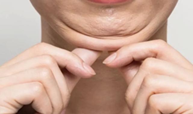 Gıdı Lazer Lipoliz (Lazer ile Gıdı Estetiği) nedir, nasıl yapılır?