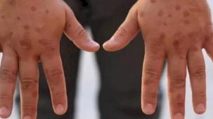 Maymun çiçeği virüsü hakkında bilinen yanlışlar