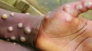 Maymun çiçeği virüsü nedir ve nasıl bulaşır?