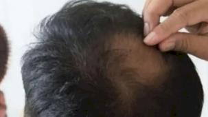 Kış aylarında saç dökülmesine dikkat!