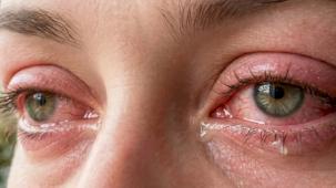 Baharın habercisi... Alerjik Konjonktivit